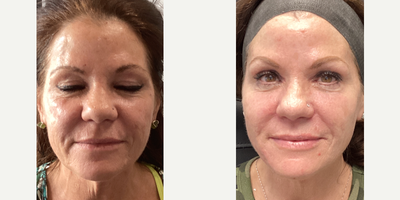 35-44 year old woman treated with Secret RF, Microneedling, Alastin Skincare, Cheek Fillers, Dysport - Full Facial Rejuvination with Secret RF microneedlingwith PRP, PDO lifting threads, Cheek filler and Alastin Skincare.