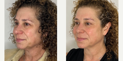 55-64 year old woman treated with Microneedling RF, CO2 Laser - 60 year old after 2 sessions of RF Microneedling + 2 CO2 micropeel