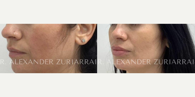 35 year old woman treated with Facial Fat Transfer - 35 year old woman treated with Facial Fat Transfer
