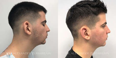 Man treated with Ear Surgery - Man treated with Ear Surgery