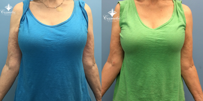 75 and up year old woman treated with Emtone - Improved skin appearance with decreased irregularities and wrinkles