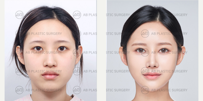 18-24 year old woman treated with Double Eyelid Surgery, Ptosis Surgery, Canthoplasty, Genioplasty, Jaw Reduction, Cheekbone Red - Genioplasty, Mandible Jaw Reduction, Cheekbone ReductionNon-Incisional Double Eyelid Revision, Ptosis Correction, Epicanthoplasty, Lateral CanthoplastyRhinoplasty (Nose Ridge+Nose Tip+Osteotomy+Bulbous Nose Correction+Hump Correction)