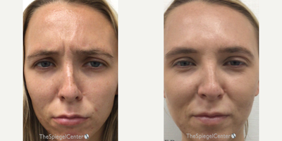 25-34 year old woman treated with Xeomin - botulinum