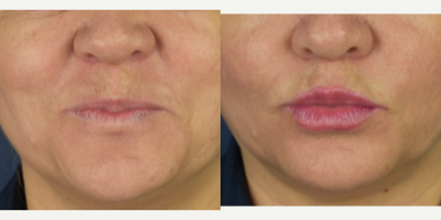 45-54 year old woman treated with Lip Lift, Lip Surgery, Lip Repositioning, Lip Fillers - Female patient who want more shape and volumen on her lips, she was concern about her upper lip looks to long. I performed a bullhorn lip lift, and fat transfer to the upper and lower lip. Now she has more youthful appearances , more volumen, definition and lipo projection.