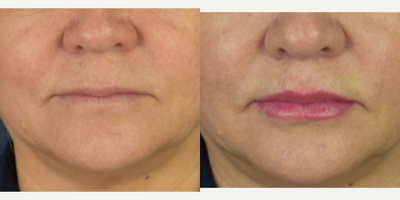 45-54 year old woman treated with Lip Lift, Lip Surgery, Lip Repositioning, Lip Fillers - Female patient who want more shape and volumen on her lips, she was concern about her upper lip looks to long. I performed a bullhorn lip lift, and fat transfer to the upper and lower lip. Now she has more youthful appearances , more volumen, definition and lipo projection.