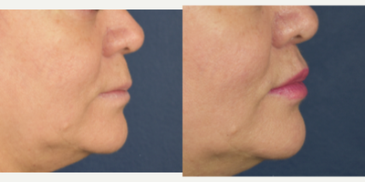 45-54 year old woman treated with Lip Lift, Lip Surgery, Lip Repositioning, Lip Fillers - Female patient who want more shape and volumen on her lips, she was concern about her upper lip looks to long. I performed a bullhorn lip lift, and fat transfer to the upper and lower lip. Now she has more youthful appearances , more volumen, definition and lipo projection.