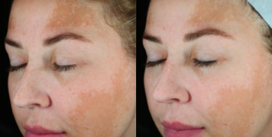 Woman treated with Glacial Rx - Woman treated with Glacial Rx