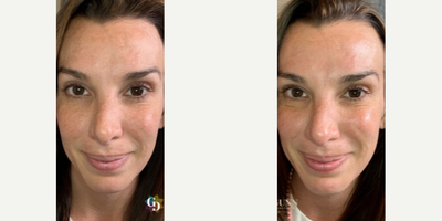 Woman treated with DiamondGlow - Diamond Glow is the only 3x1 simultaneous exfoliation, extraction, and infusion procedure on the market. The patient below has been treated with a customized tip and serum to brighten the skin while smoothing fine lines and wrinkles. 