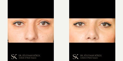 35-44 year old woman treated with Breast Implants, Breast Augmentation, Rhinoplasty - Breast Augmentation with 400cc High Profile Implants + Rhinoplasty