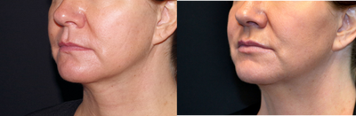 45-54 year old woman treated with Lip Implants - 46 year old female received a lip augmentation with PermaLip implant; photos depict the patient's results 3 months post-op.