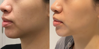 25-34 year old woman treated with Thermage FLX - age 25-34 years old woman treated with Thermage FLX 900 shots on lower face