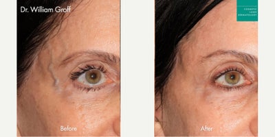 VBeam for Veins by Dr. Groff - VBeam for Veins by Dr. Groff