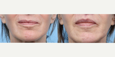 65-74 year old woman treated with Lip Lift - Dr. Wise performed a lip lift on this 70-year-old patient to shorten the relative length of the upper lip which imparts improved proportion between the upper and lower lips.