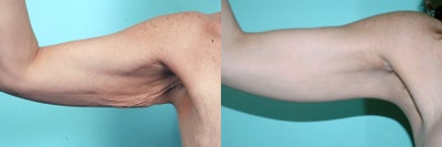 Arm Lift - 
	Former Dr. Quiroz&nbsp;patient, who had an Arm Lift.&nbsp;