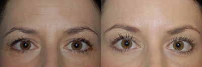 Brow Lift - 
	Brow Lift, Female
