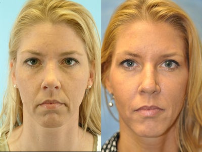 44 Year Old Female Treated for Unwanted Facial Lines - 
	44 Year Old Female

	Diagnosis: Unwanted Facial Lines

	Procedure: Juvederm Dermal Filler to Nasolabial Folds/Marionette Lines and Botox Injection to Glabella and Crows Feet
