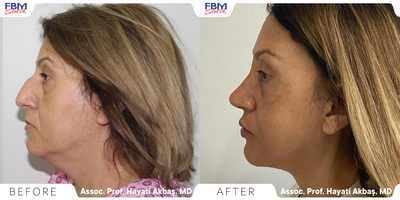 45-54 year old woman treated with Lower Facelift, Neck Lift, Rhinoplasty, Deep Plane Facelift, Eyelid Surgery, Cheek Lift - A patient suffering from a double chin, hooked nose, double eyelids . she was treated with lower face lift , deep plane face lift , blepharoplasty, rhinoplasty and facial fat transfer