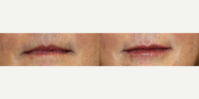55-64 year old woman treated with Juvederm - 1 syringe of filler to lips to give a slight enhancement. The lines around the lips were softened as well. The after photo was taken immediately post injection.