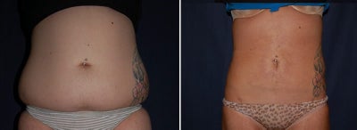 Liposuction abdomen+ waist - 20yrs old, 5'5, no kids, 9 months postop on right