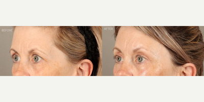 Temporal Brow Lift, Upper Blepharoplasty and Full-Face Fractionated CO2 Laser - 58-year-old female who was concerned about her eyes looking tired. She is shown 6 months after a temporal (lateral) endoscopic-style brow lift, upper blepharoplasty and full-face fractionated CO2 laser. The combination of surgeries created a more youthful upper eye contour, relieved tension on her forehead and refreshed her skin.
