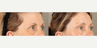 Temporal Brow Lift, Upper Blepharoplasty and Full-Face Fractionated CO2 Laser - 58-year-old female who was concerned about her eyes looking tired. She is shown 6 months after a temporal (lateral) endoscopic-style brow lift, upper blepharoplasty and full-face fractionated CO2 laser. The combination of surgeries created a more youthful upper eye contour, relieved tension on her forehead and refreshed her skin.