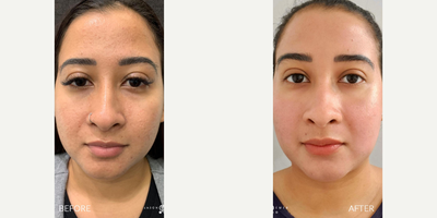 Woman treated with Halo Laser, ProFractional Laser - Woman treated with Halo Laser, ProFractional Laser