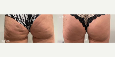 Woman treated with Qwo - Woman treated with Qwo
