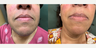 45-54 year old woman treated with Laser Hair Removal - Before and after 5 laser hair removal treatments spaced 1 month apart.