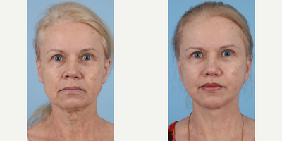 Woman treated with Facelift Revision, Neck Lift, Lip Lift - Face and neck lift revision (secondary, deep plane technique, lip lift, chin augmentation, fat transfer, alar reduction