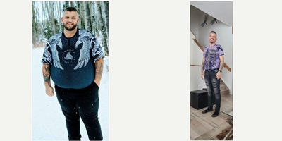 35-44 year old man treated with Gastric Bypass - Gastric Bypass Surgery performed in Mexico by Dr Alejandro Lopez