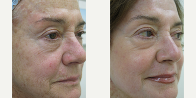 65-74 year old woman treated with Chemical Peel - Customized Chemical Peel