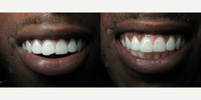 25-34 year old man treated with Tooth Repair - Tooth repair with composite bonding.