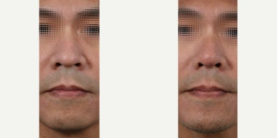 Man treated with Asian Rhinoplasty - Man treated with Asian Rhinoplasty