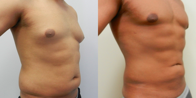 35-44 year old man treated with Liposuction - 35-44 year old man treated with Vaser Liposuction (back, chest, waist, breast, abdominal area, hips)
