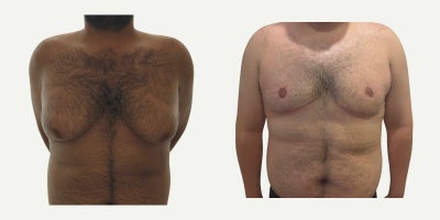 25-34 year old man treated with Breast Reduction - gynecomastia treatment