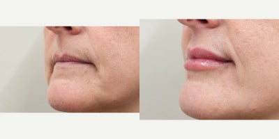45-54 year old woman treated with Lip Fillers, Revanesse, Restylane - Needed Lip Renaissance with natural results