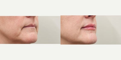 45-54 year old woman treated with Lip Fillers, Revanesse, Restylane - Needed Lip Renaissance with natural results