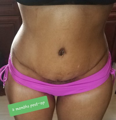 Steph Abeles  Comparison of my tummy tuck scar after one year and