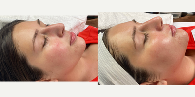 25-34 year old woman treated with Dermaplaning - Before and after of a dermaplaning treatment! After pictures were taken immediately after treatment.