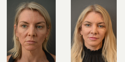 45-54 year old woman treated with Facelift - 45-54 year old woman treated with High SMASFacelift and Neck Lift, Fat Grafting, Chemical Peel and Dermabrassion.