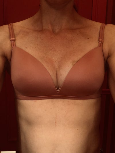 Breast Fat Transfer: From 32A to 32C - 42 years old, with kids 