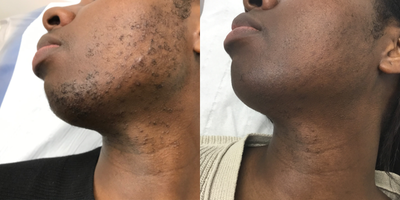 25-34 year old woman treated with Laser Hair Removal - 25-34 year old woman treated with Laser Hair Removal on Face, reduced ingrown hair and suppressed excessive hair growth