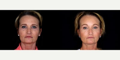 52 year old woman treated with Brow Lift, Facial Fat Transfer, Mini Facelift - 52 year old woman treated with Brow Lift, Facial Fat Transfer, Mini Facelift. Photos depict before and 4 months after surgery
