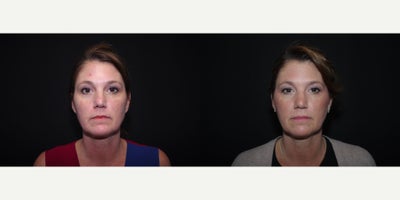 45-54 year old woman treated with Perlane - 46 year old female was treated with Refyne (Perlane); photos depict the patients results 5 weeks post-op.