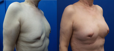 65-74 year old woman treated with Breast Fat Transfer - 67-year-old lady underwent bilateral breast augmentation. The patient had her breast implants removed, and Dr. Tehrani performed one session of an autologous fat transfer to the breasts.