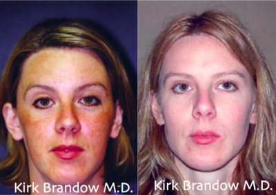 35-44 year old woman treated with Blue Peel - This patient was treated by Dr. Brandow with a Blue Peel and Facial Enhancement Procedures.