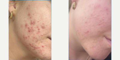 Woman treated with Clear and Brilliant, Laser Resurfacing - Clear & Brilliant Laser and Cooltouch CT3 are great lasers for NO DOWNTIME acne treatment!