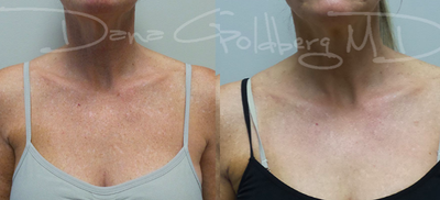 IPL - 45-54 year old woman treated with one treatment of IPL to the neck and chest to erase dark spots and improve texture of the skin
