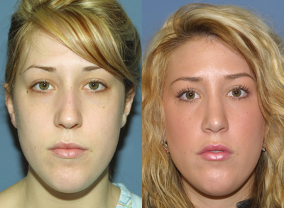 Woman treated with Rhinoplasty - Woman treated with Rhinoplasty