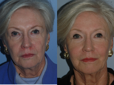 Sculptra treatment - 
	Procedure: Sculptra treatment with two vials, two treatments six weeks apart. Patient also had radiesse to the nasolabial folds, oral commissures, marionette lines and pre-jowl hollow